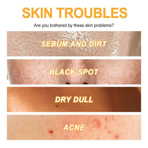 Vitamin C Peeling-Gel gegen Mitesser