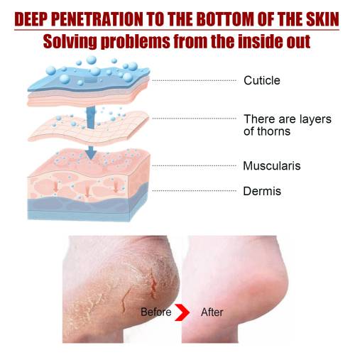 Peeling-Fußmaske mit Salicyl- und Apfelsäure