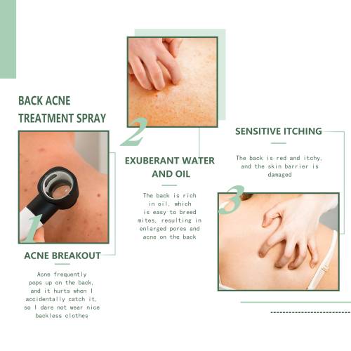 Klärendes Spray für Rücken und Körper mit Hamamelis