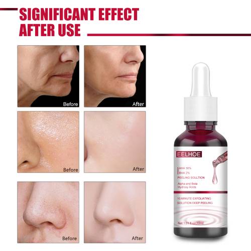 AHA 30 % + BHA 2 % Peeling-Serum