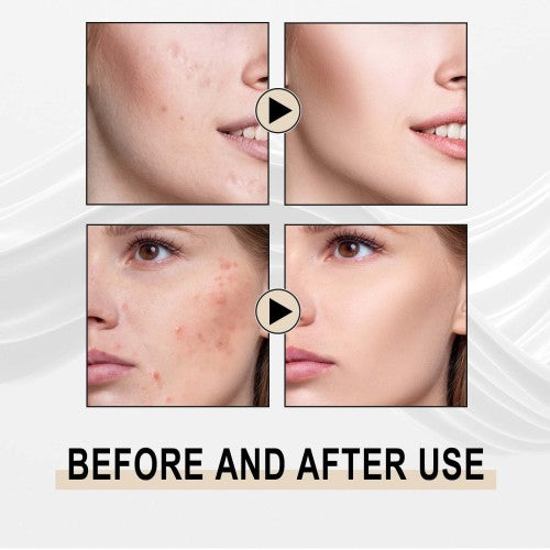 Glykolsäure Peeling-Essenz gegen Mitesser